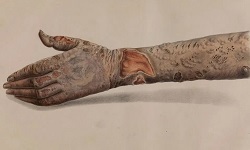 Leprosy, Hansen’s diseases